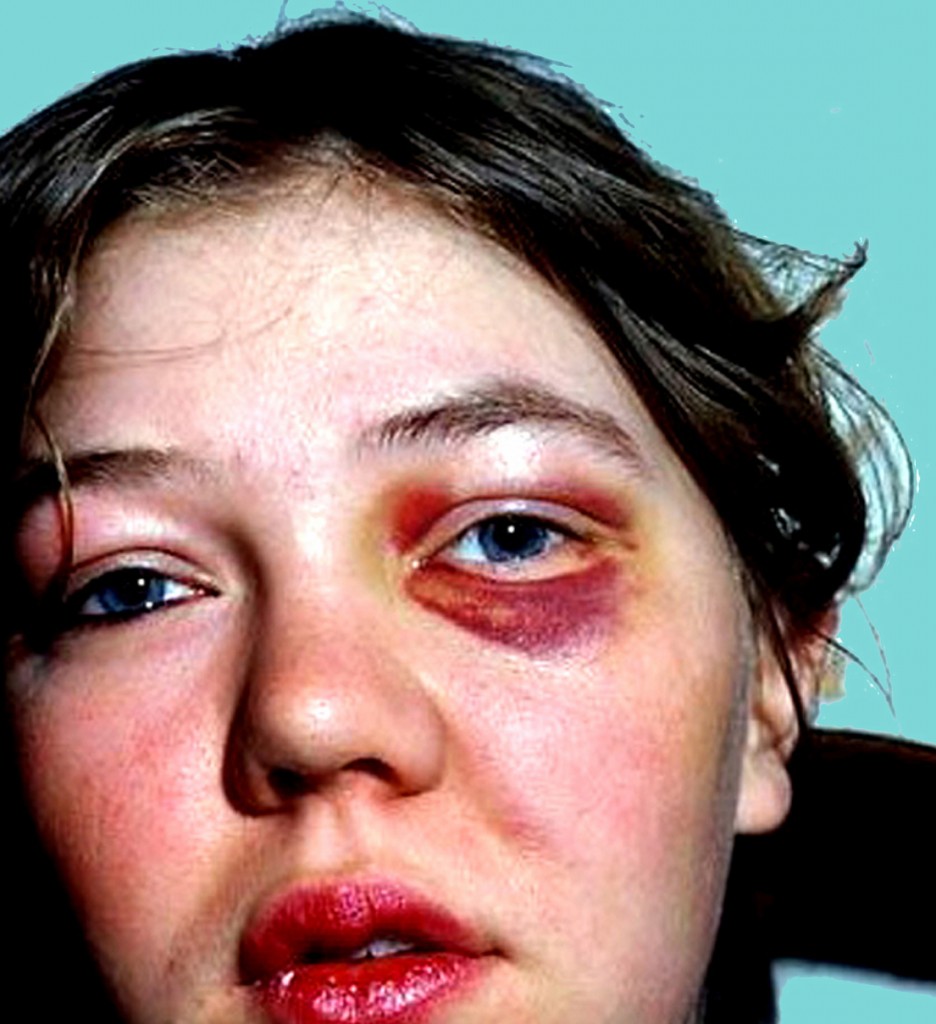 Assaulted Woman 1