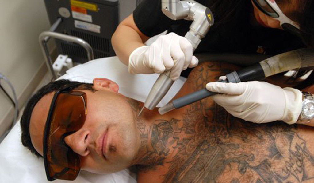laser-tattoo-removal