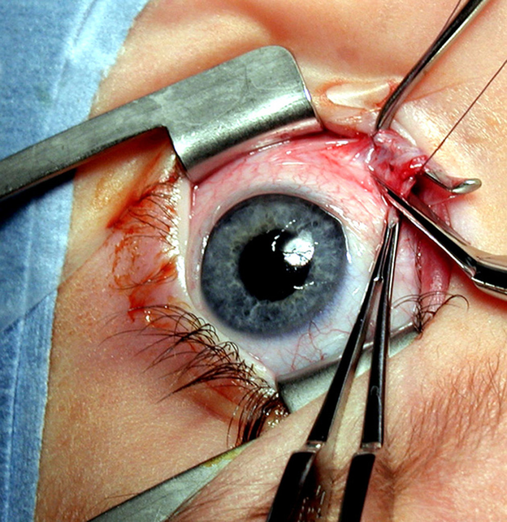 desinsertion_du_muscle_co-1986-strabismus-surgery